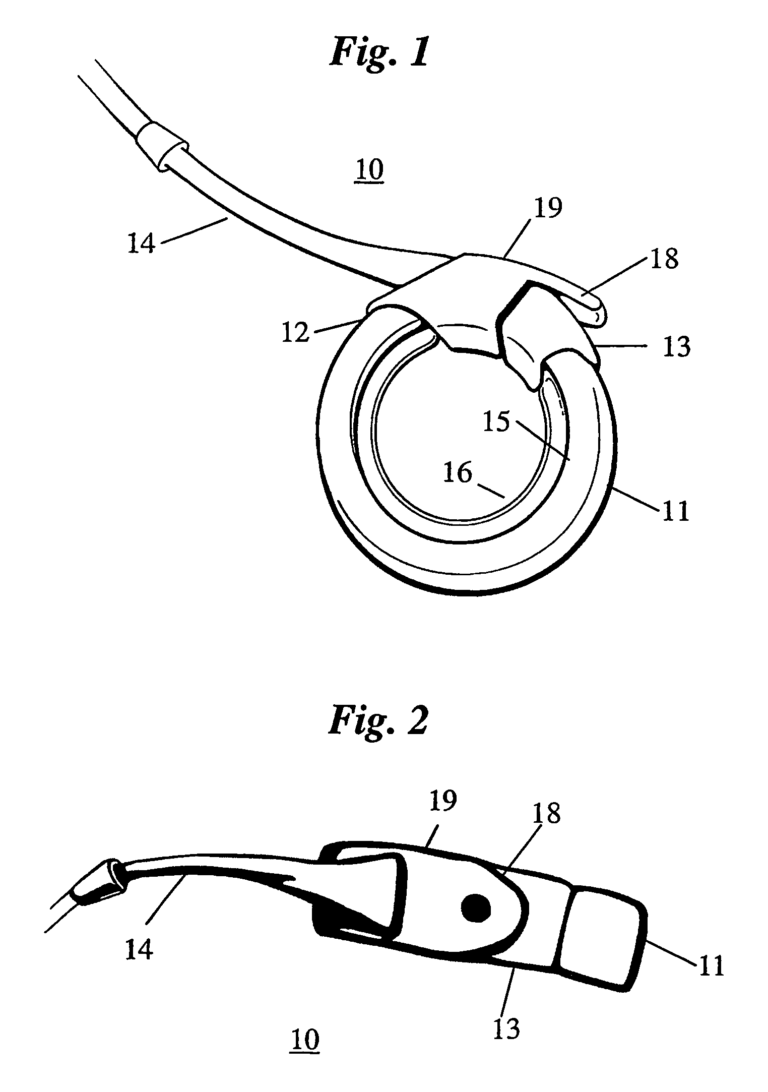 Remotely adjustable gastric banding method