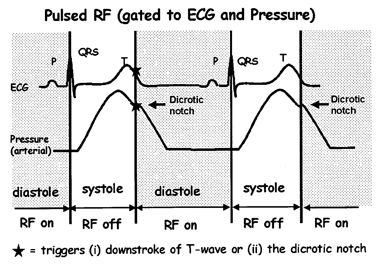 Methods and systems for gated or pulsed application of ablative energy in the treatment of cardiac disorders