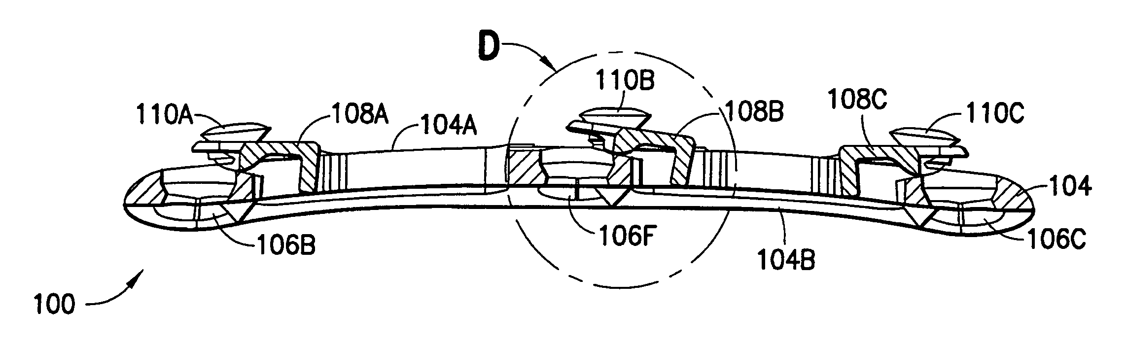 Anterior cervical plating system