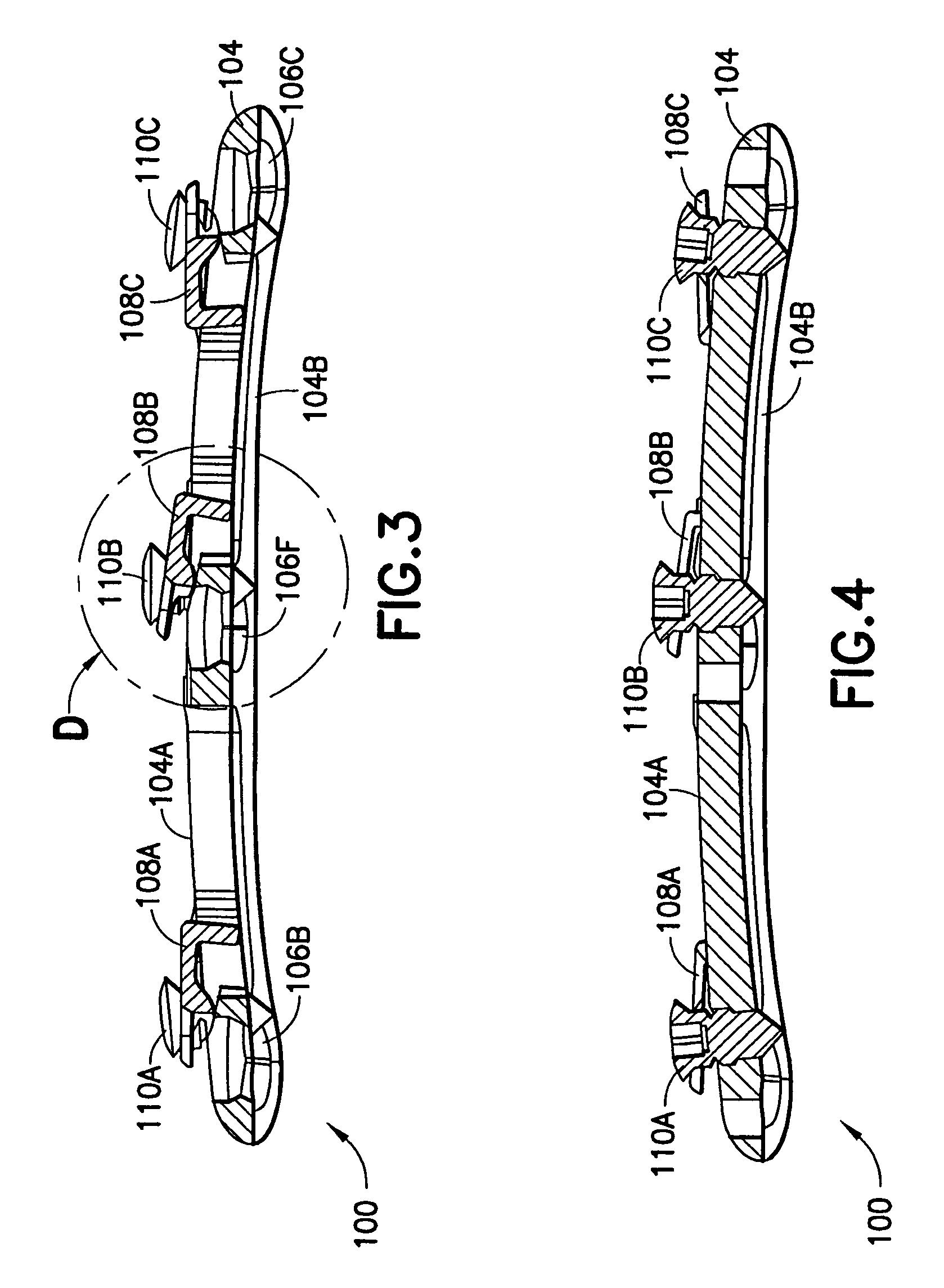 Anterior cervical plating system