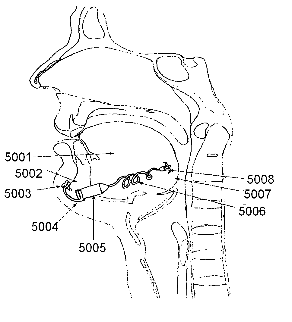 Tethered airway implants and methods of using the same