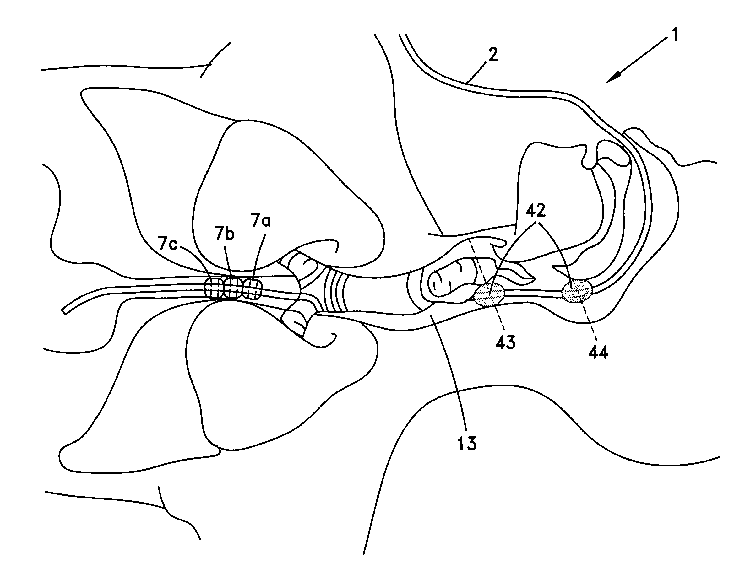 Nasogastric and orogastric feeding devices, system comprising them, methods and uses thereof