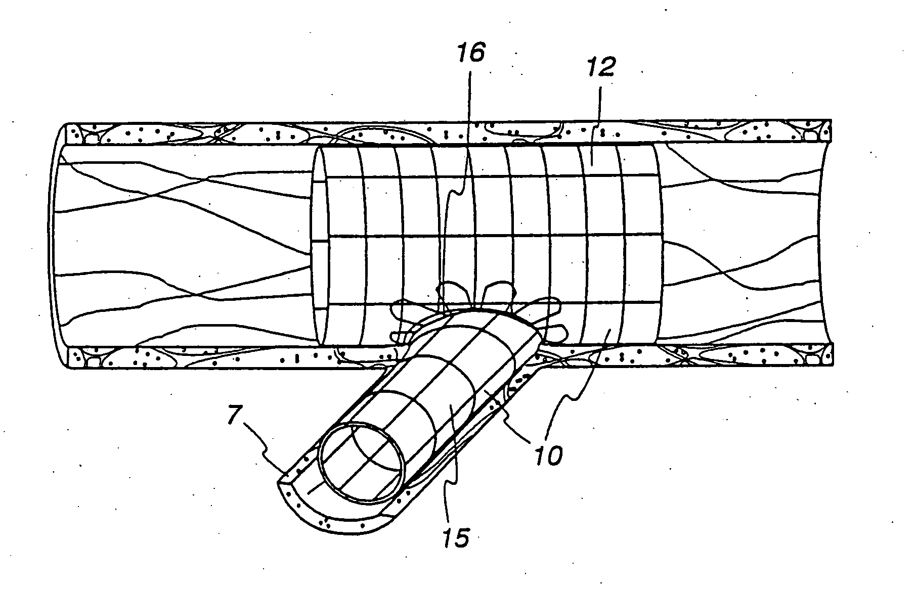 Extendible stent apparatus