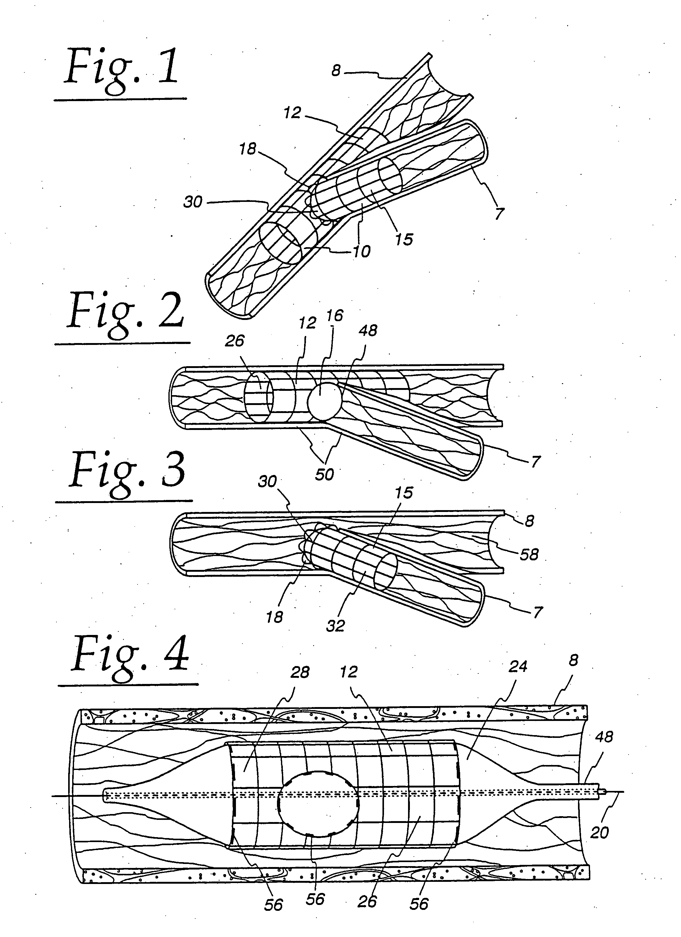 Extendible stent apparatus