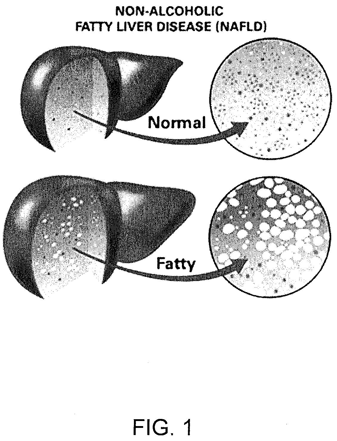 Method and system for reducing the likelihood of developing liver cancer in an individual diagnosed with non-alcoholic fatty liver disease