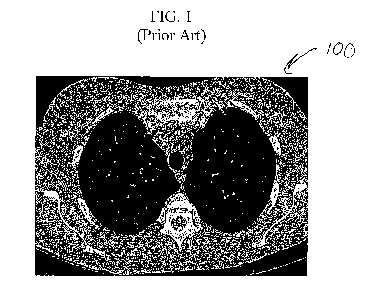 System and method for enhanced viewing of rib metastasis