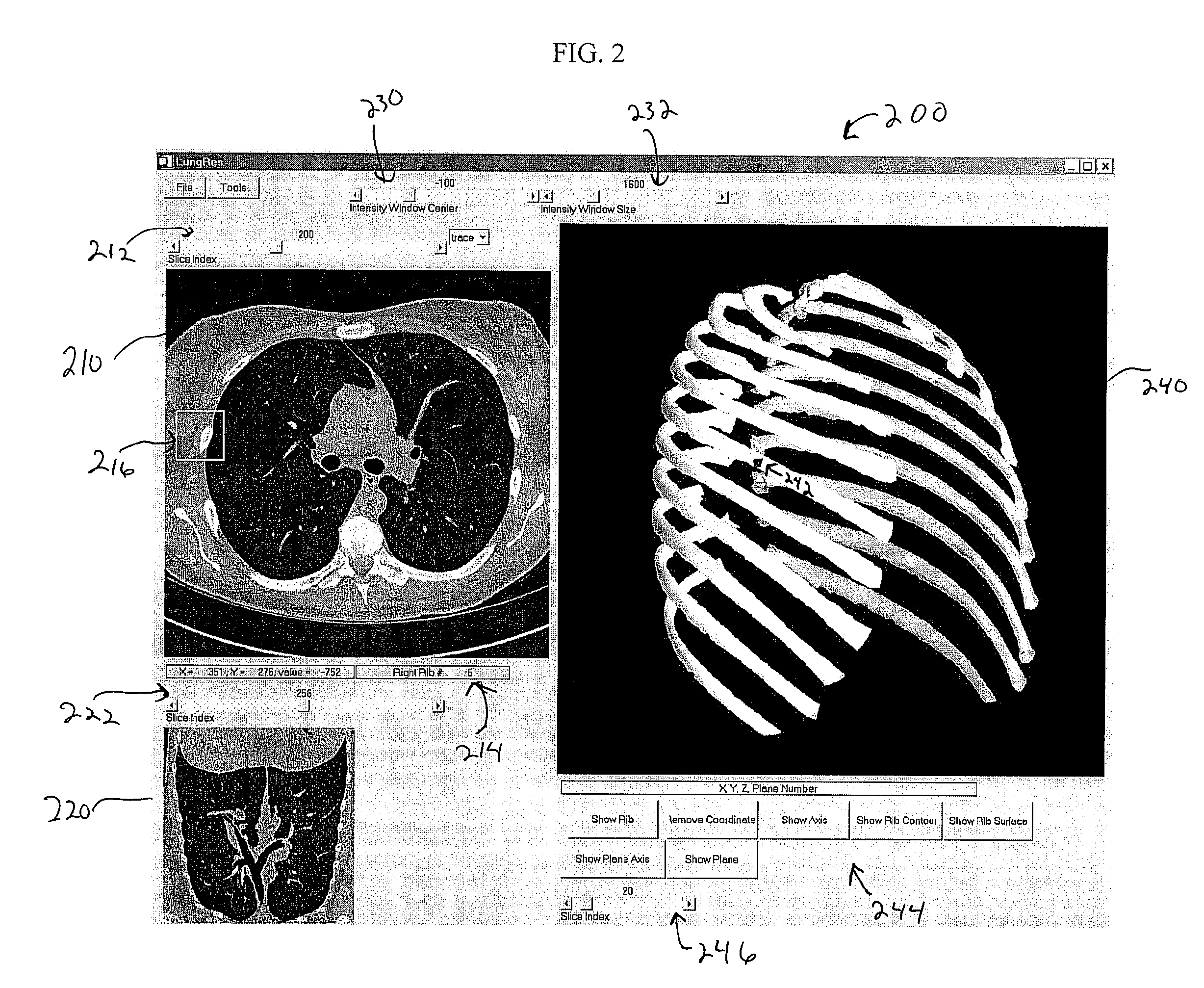 System and method for enhanced viewing of rib metastasis