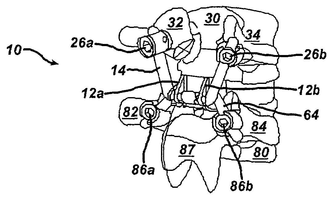 Non-linear artificial ligament system