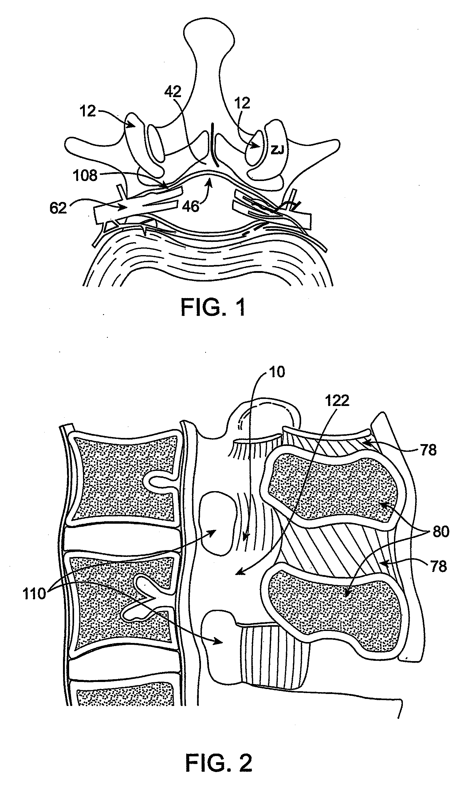 Devices and methods for selective surgical removal of tissue