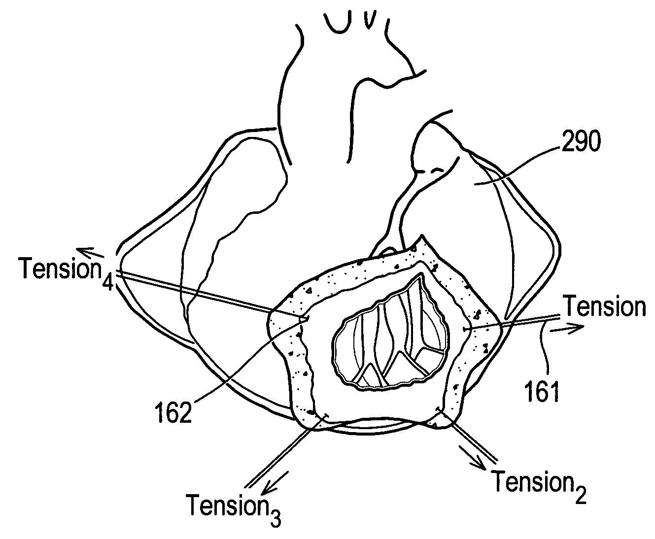 System and method for facilitating cardiac intervention