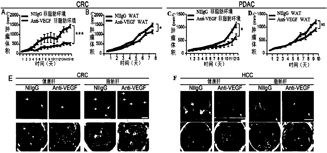 Medicament for improving drug resistance of solid tumors against anti-vascular drugs and application of CPT1a inhibitor in medicament