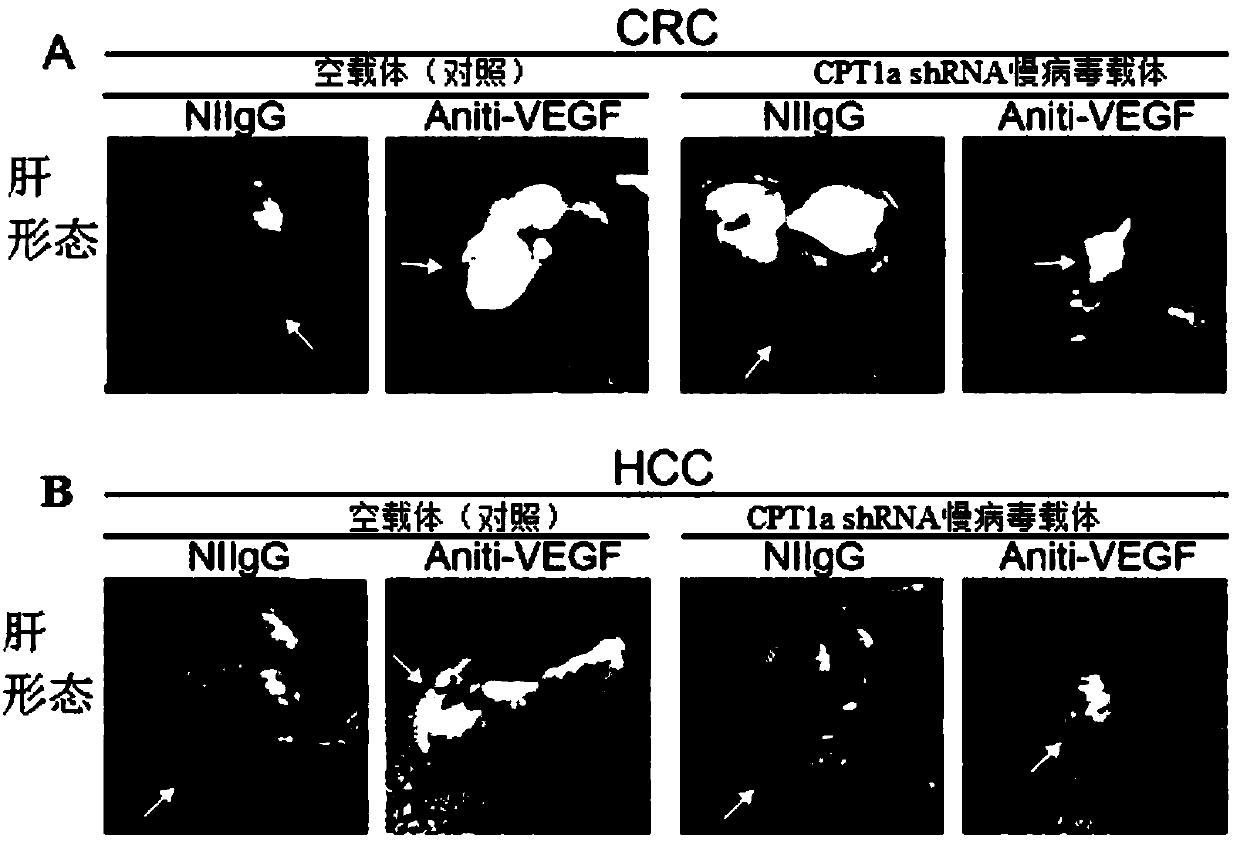 Medicament for improving drug resistance of solid tumors against anti-vascular drugs and application of CPT1a inhibitor in medicament