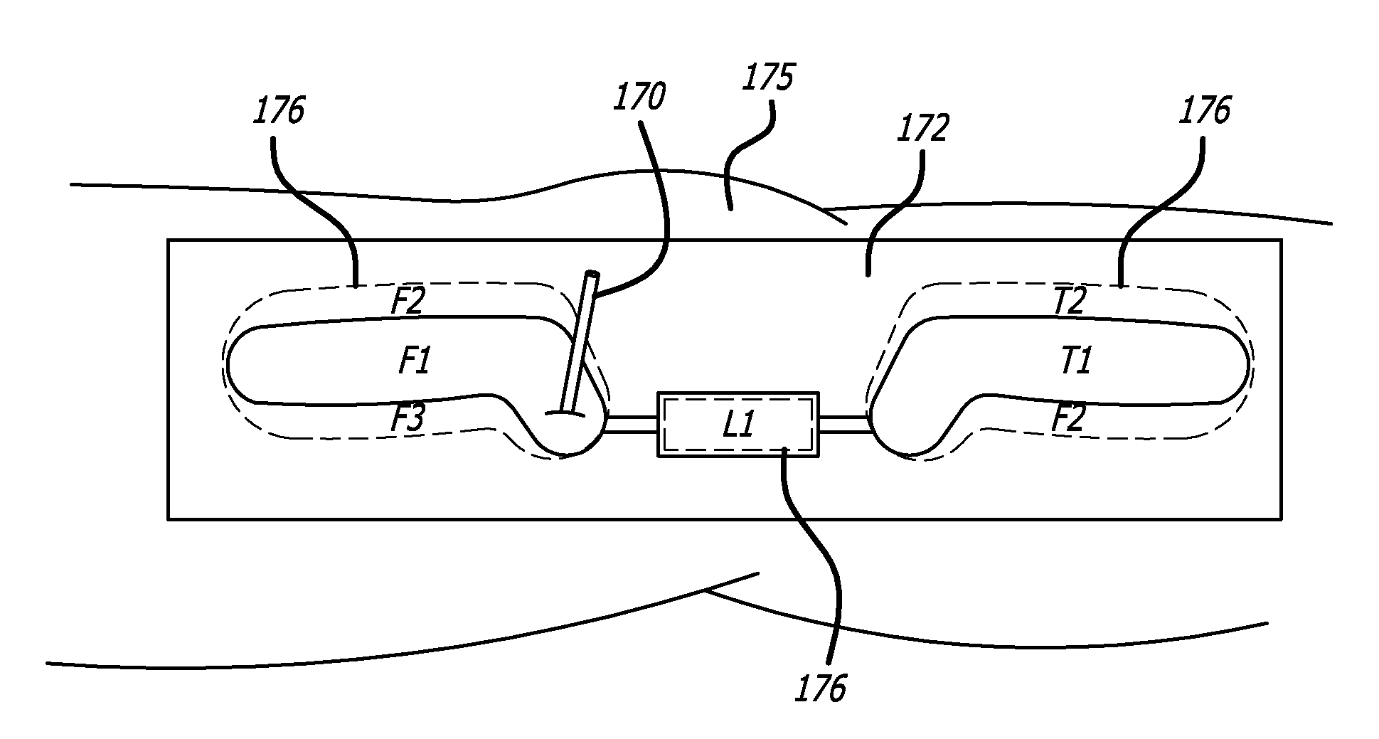 Surgical implantation method and devices for an extra-articular mechanical energy absorbing apparatus