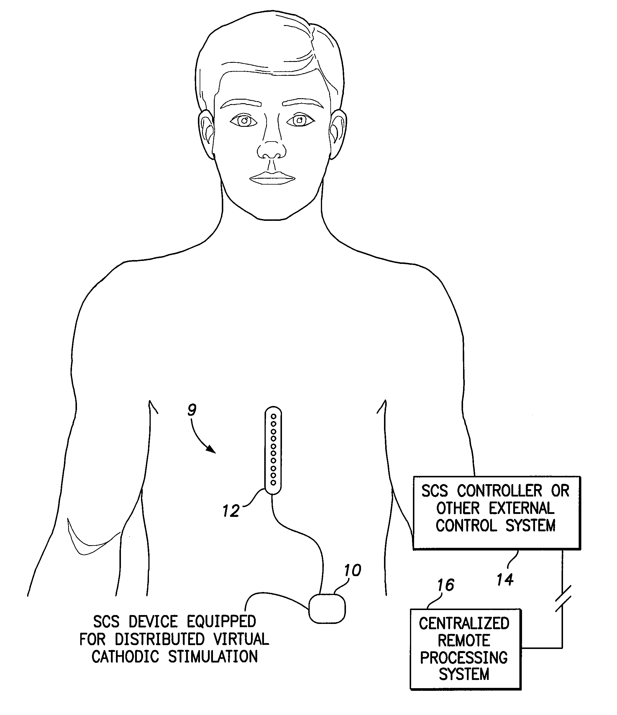 Systems and methods for providing a distributed virtual stimulation cathode for use with an implantable neurostimulation system