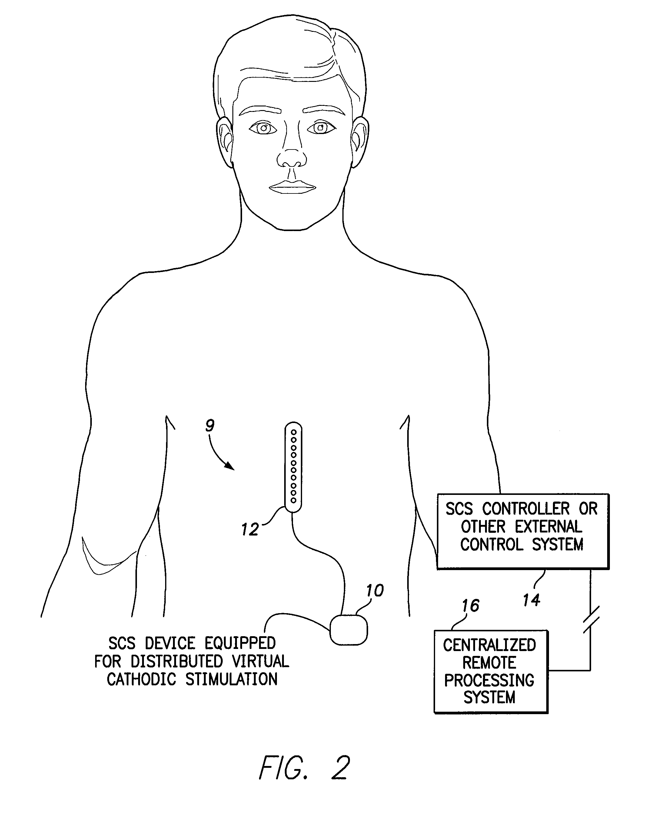 Systems and methods for providing a distributed virtual stimulation cathode for use with an implantable neurostimulation system