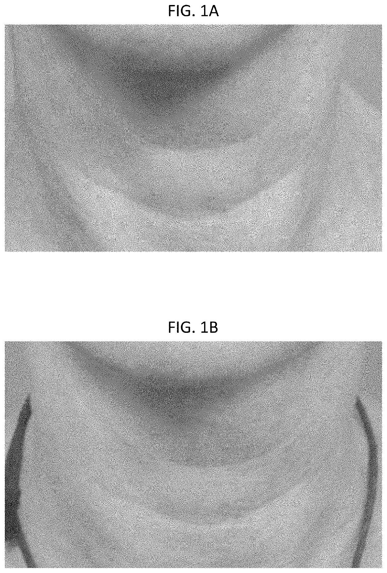 Sterile Buffered Solution Injection to Burn Tissue