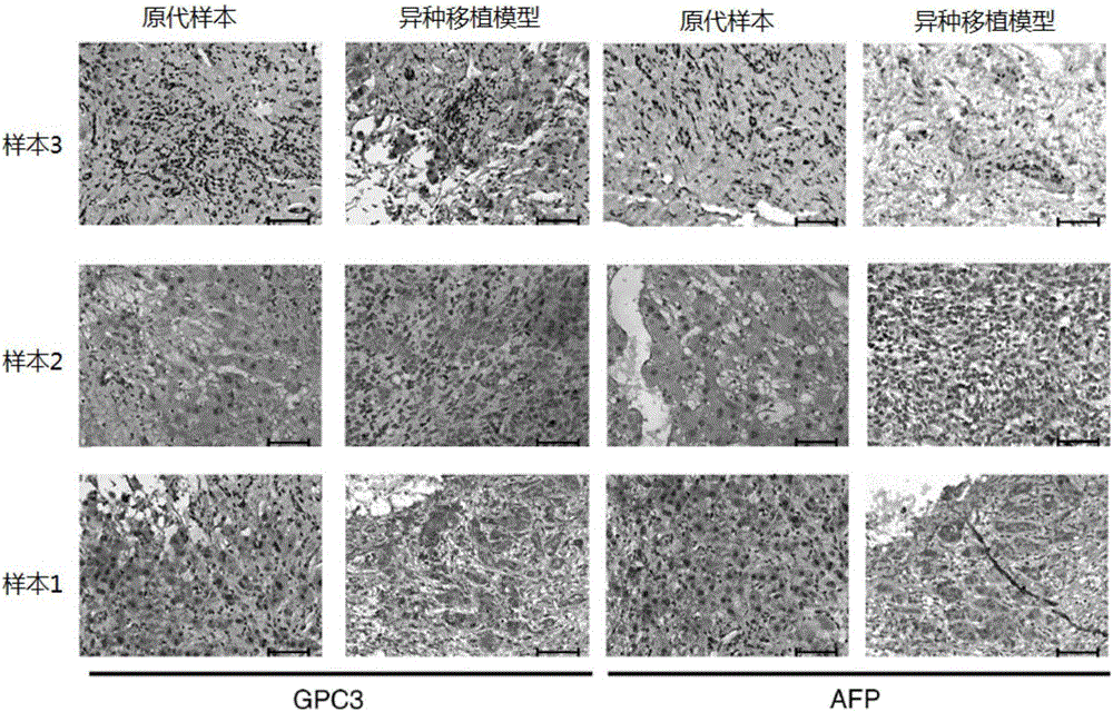 Model and method for detecting inhibiting effect of chimeric antigen receptor (CAR) T cells on hepatoma cells