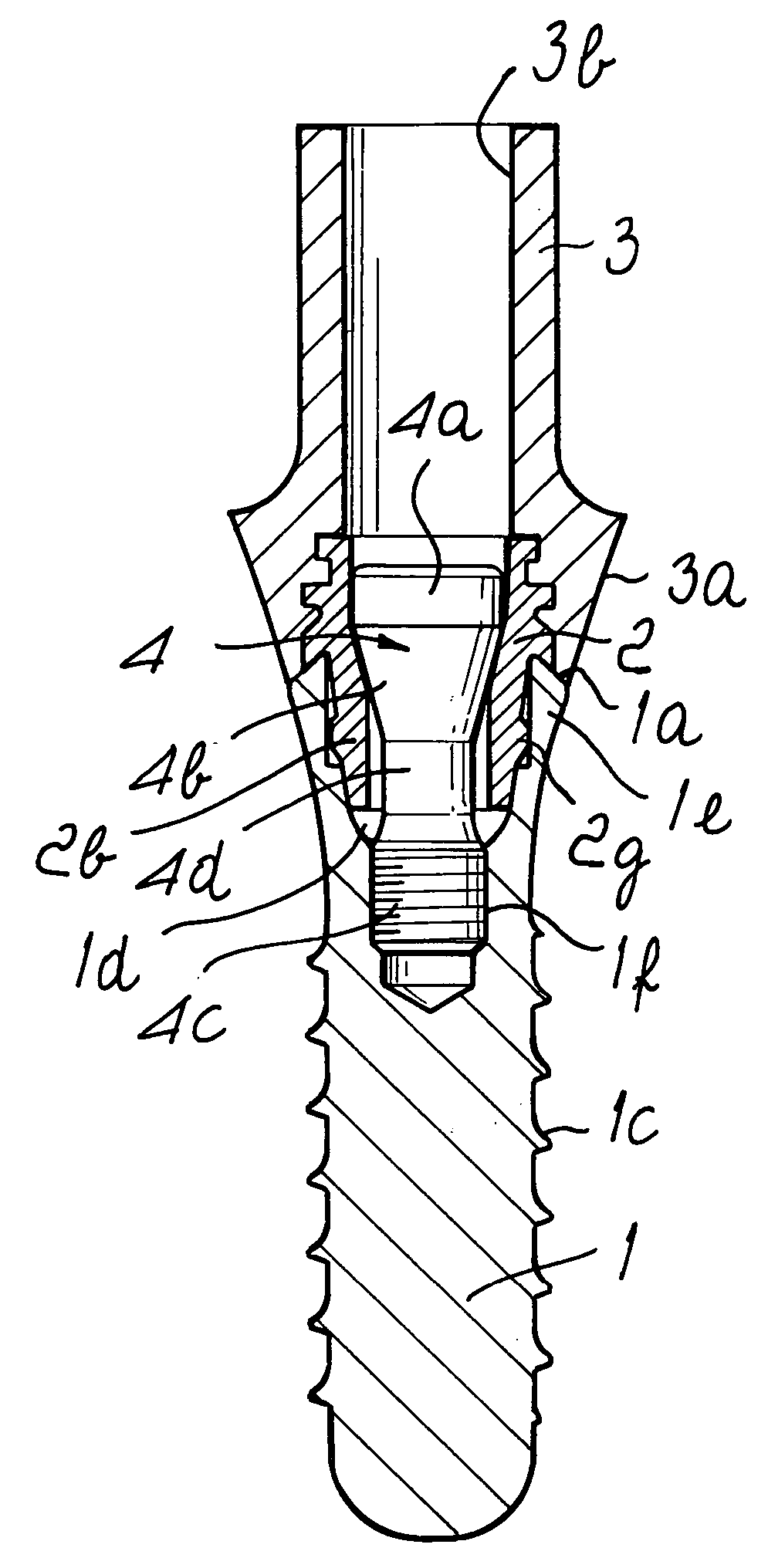 Dental implant system