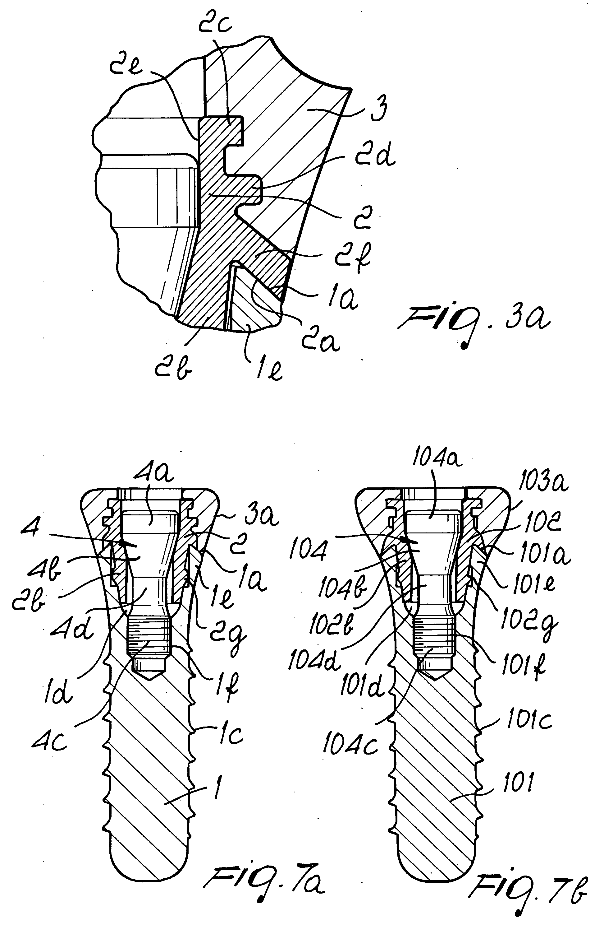 Dental implant system