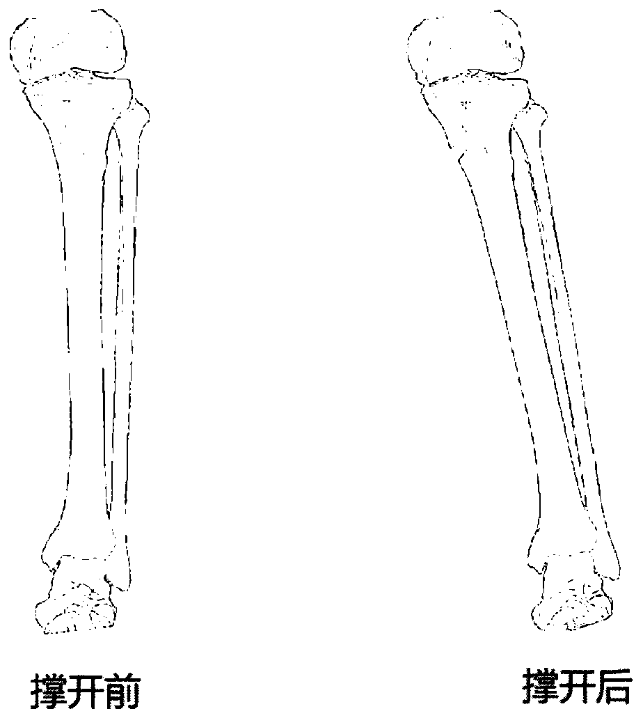 Method for constructing model of personalized high tibial osteotomy angle matching template