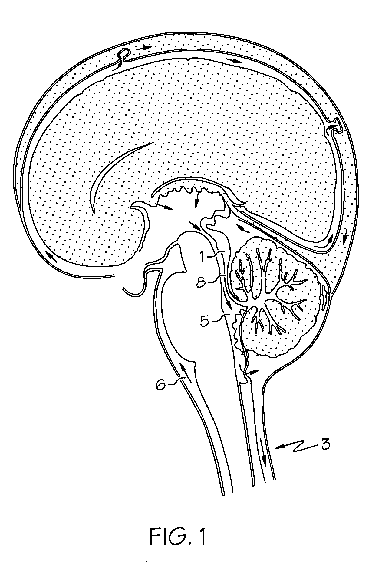 Intrathecal gabapentin for treatment of pain