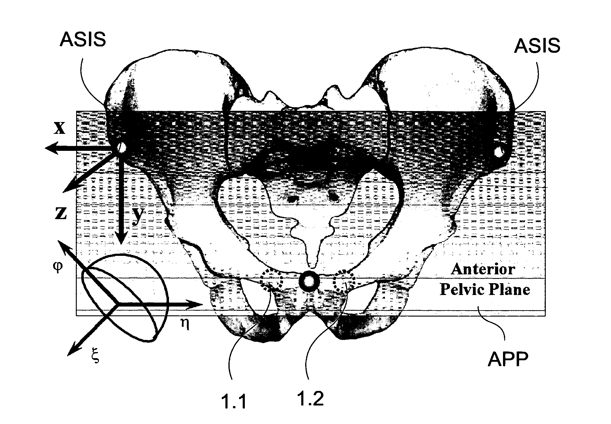 Methods and devices for patient-specific acetabular component alignment in total hip arthroplasty