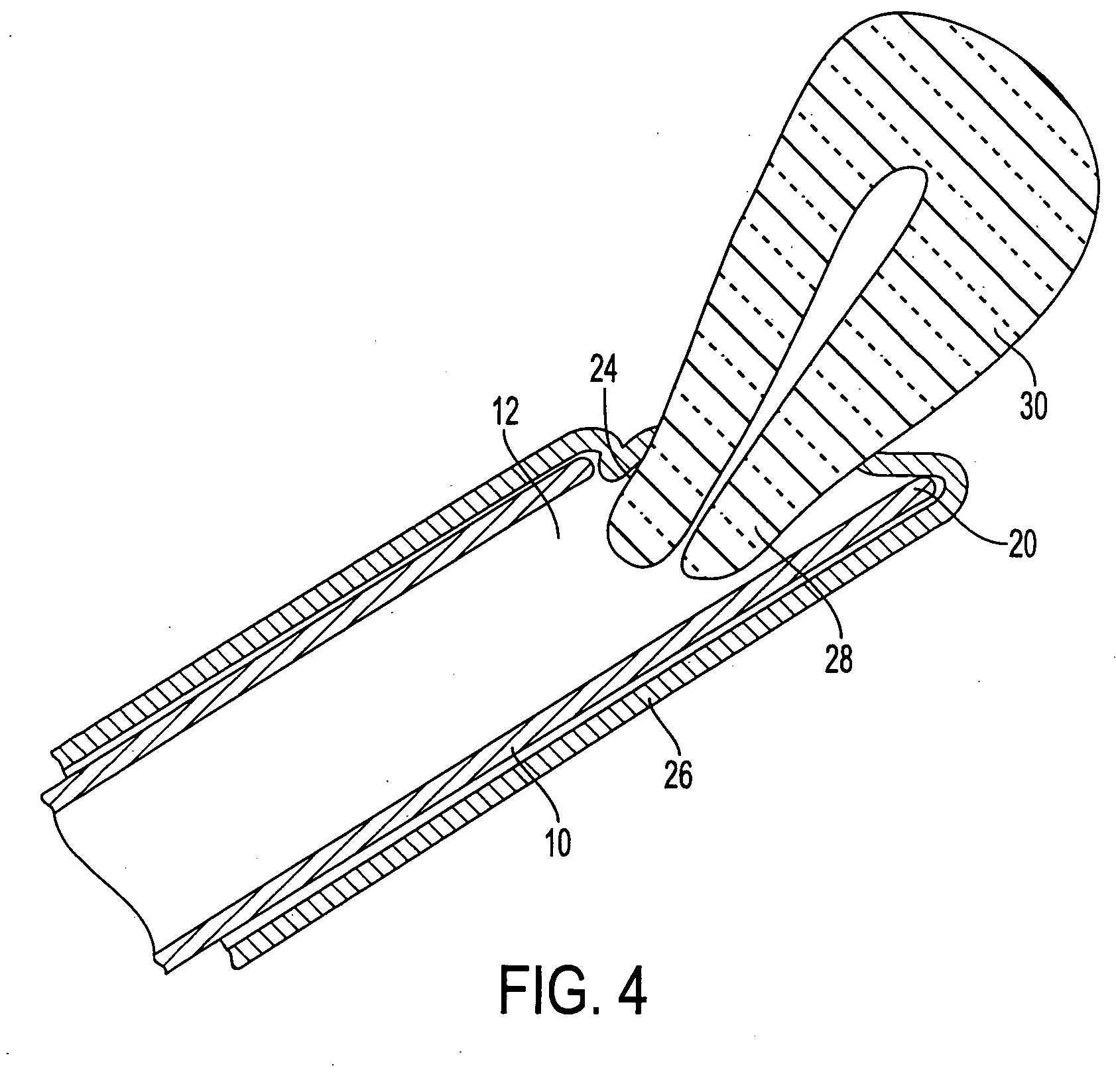 Transvaginal tube as an aid to laparoscopic surgery