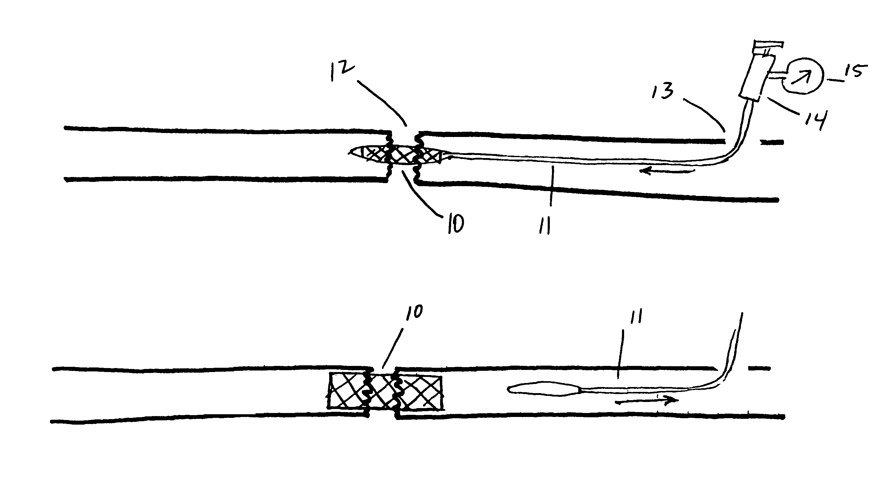 Methods and devices for treatment of bone fractures