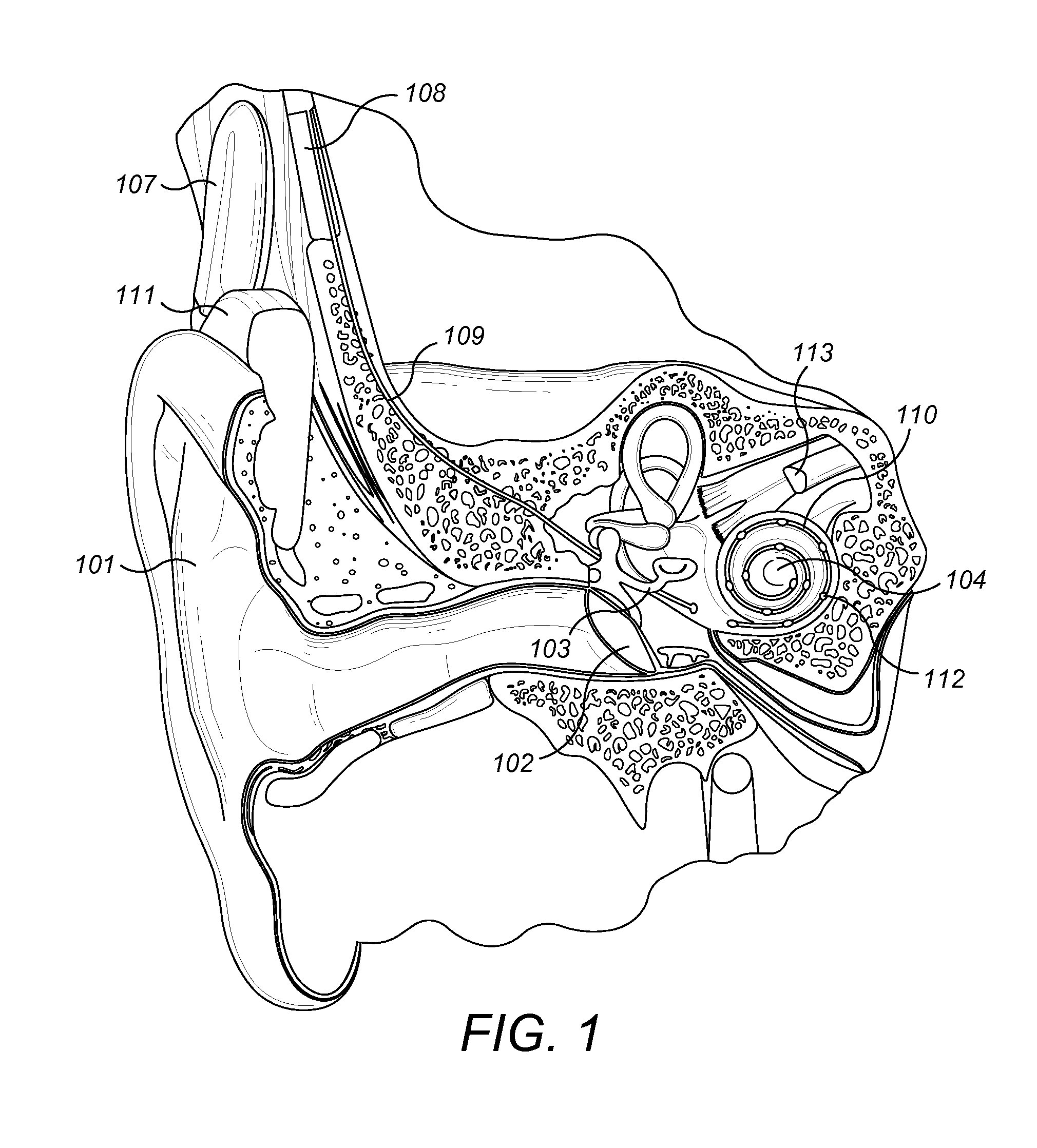 Electrode With Anti-Spring Back Component