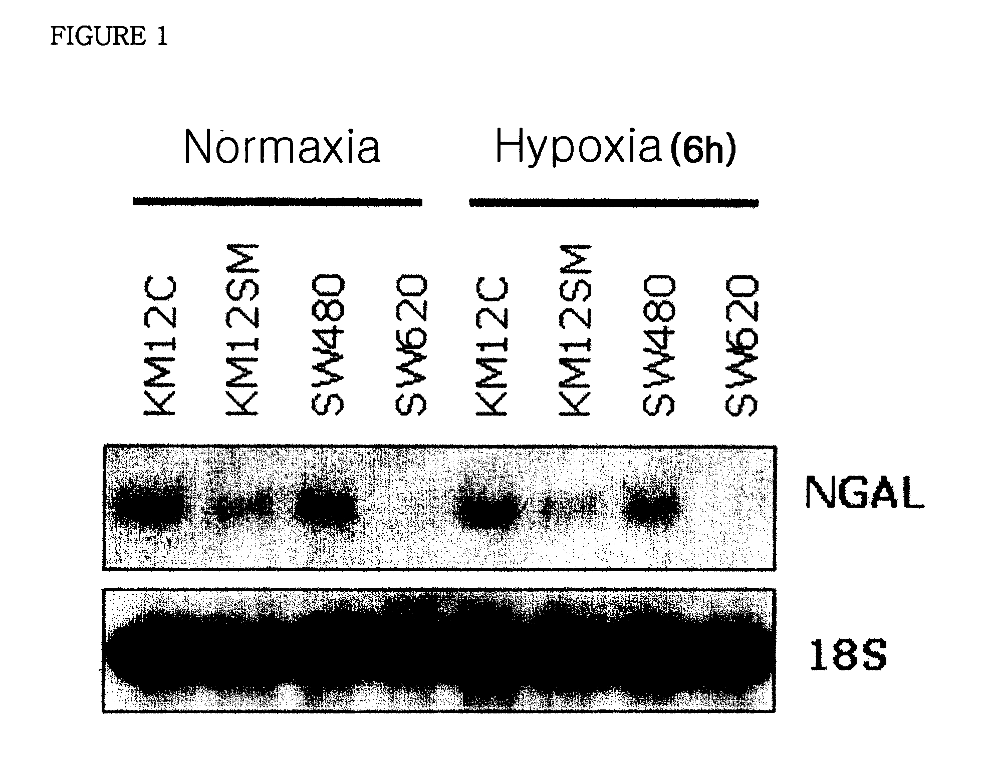 Therapeutic agent comprising lipocalin 2 against cancer metastasis, and methods of early diagnosis and inhibition of cancer metastasis using lipocalin 2