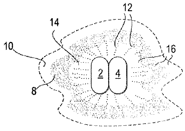 Bone implant and systems and coatings for the controllable release of antimicrobial metal ions