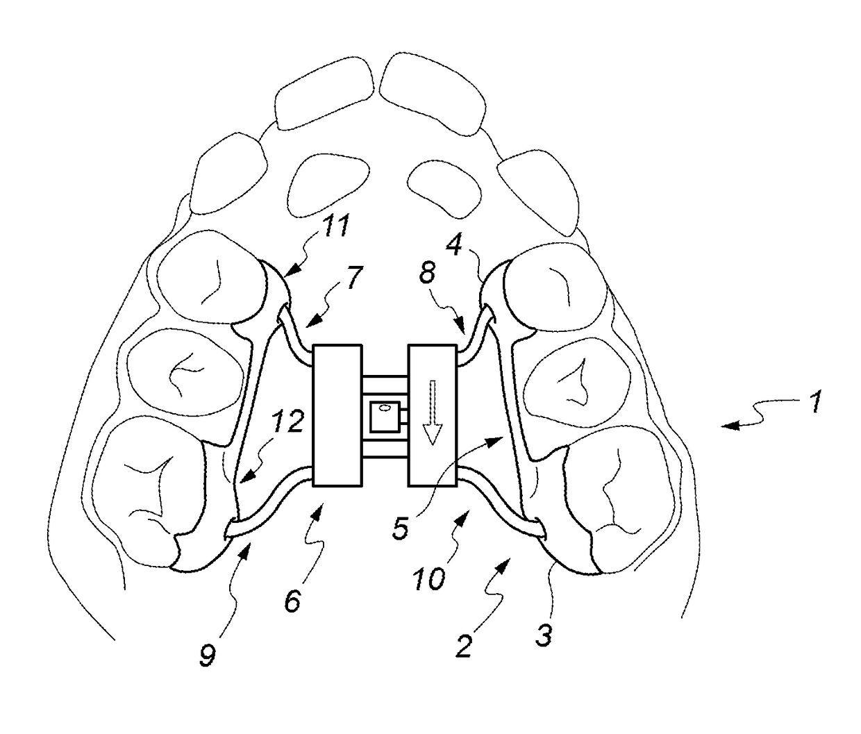 Removable rapid maxillary expander