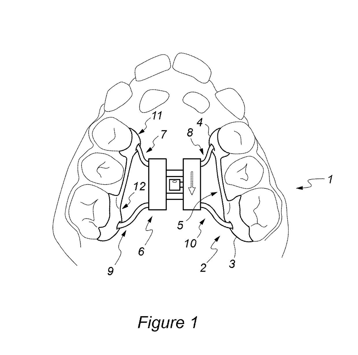 Removable rapid maxillary expander