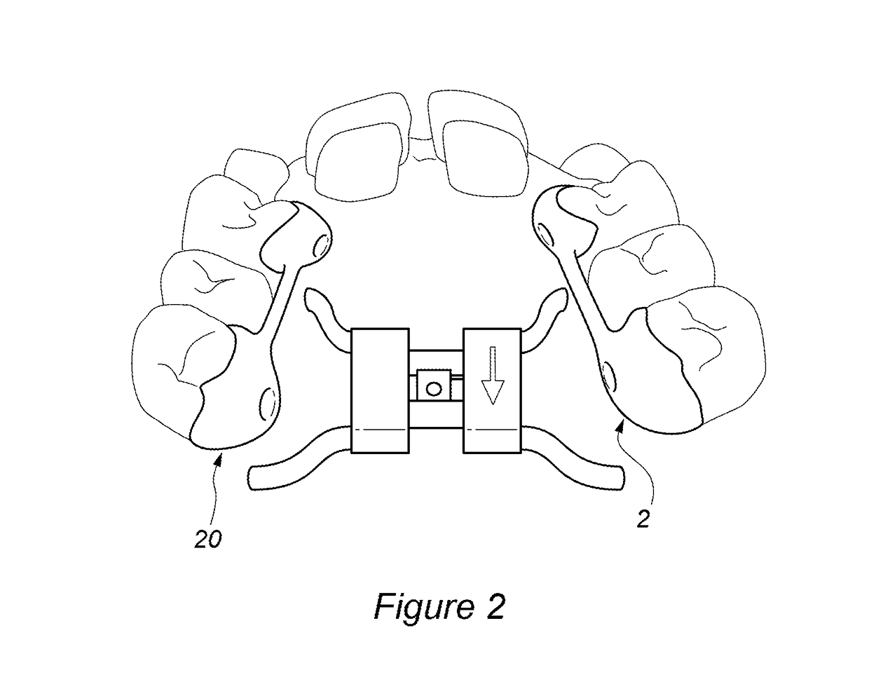 Removable rapid maxillary expander