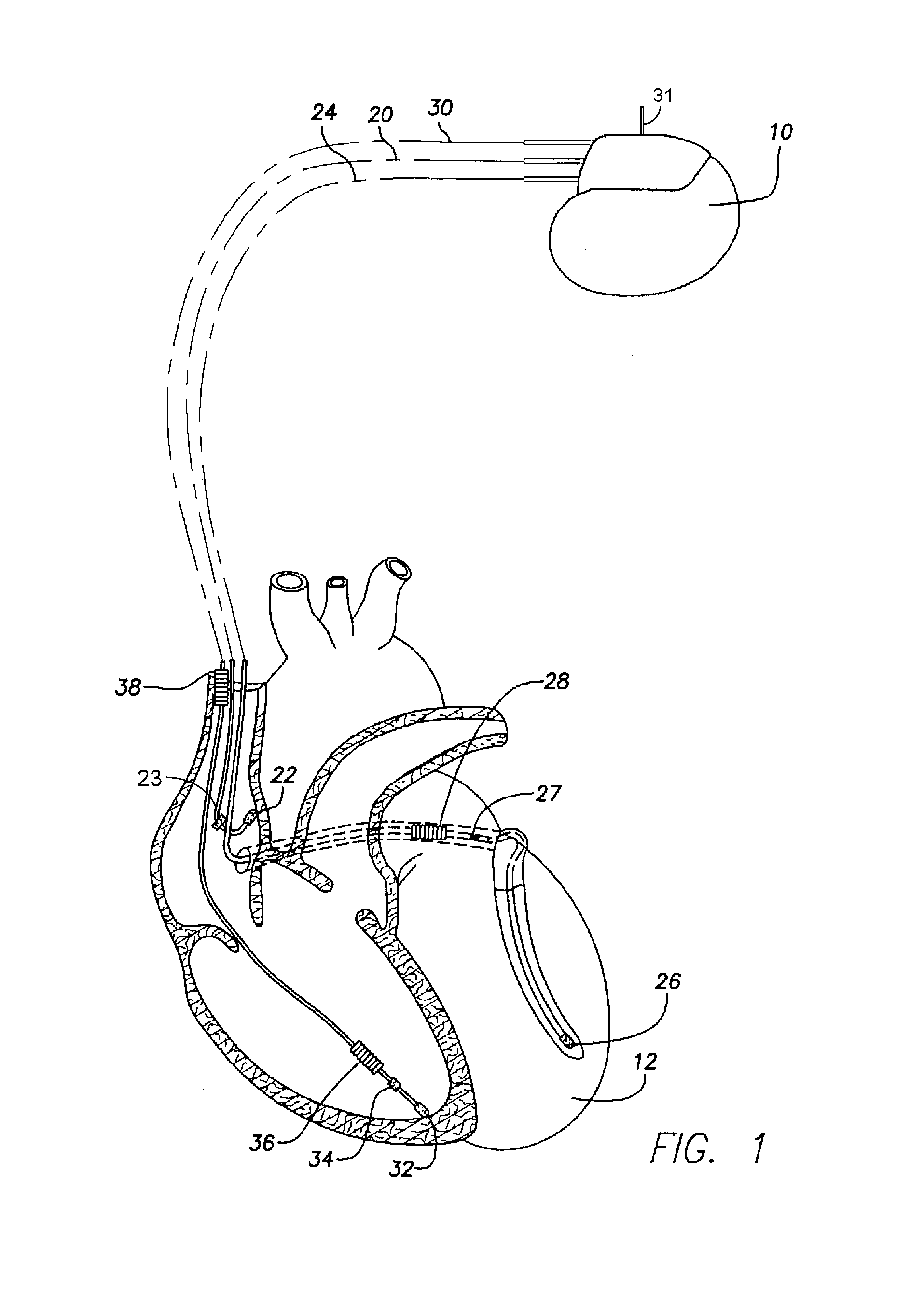 System and method for detecting cardiac ischemia based on t-waves using an implantable medical device