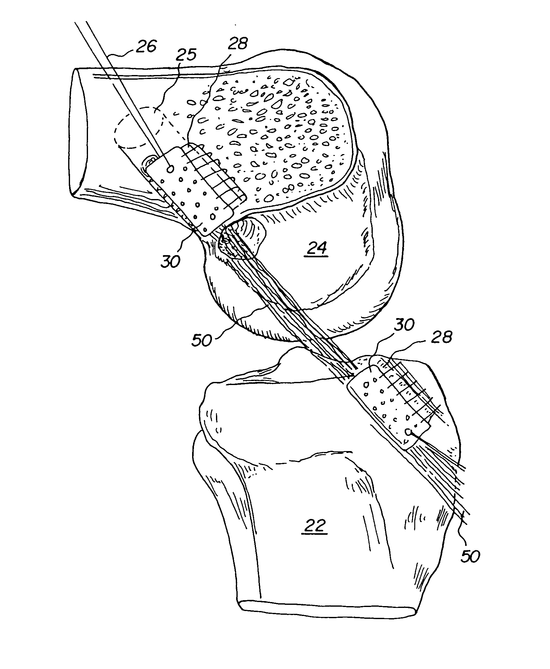 Method for inserting improved bone tendon bone assembly with allograft bone block