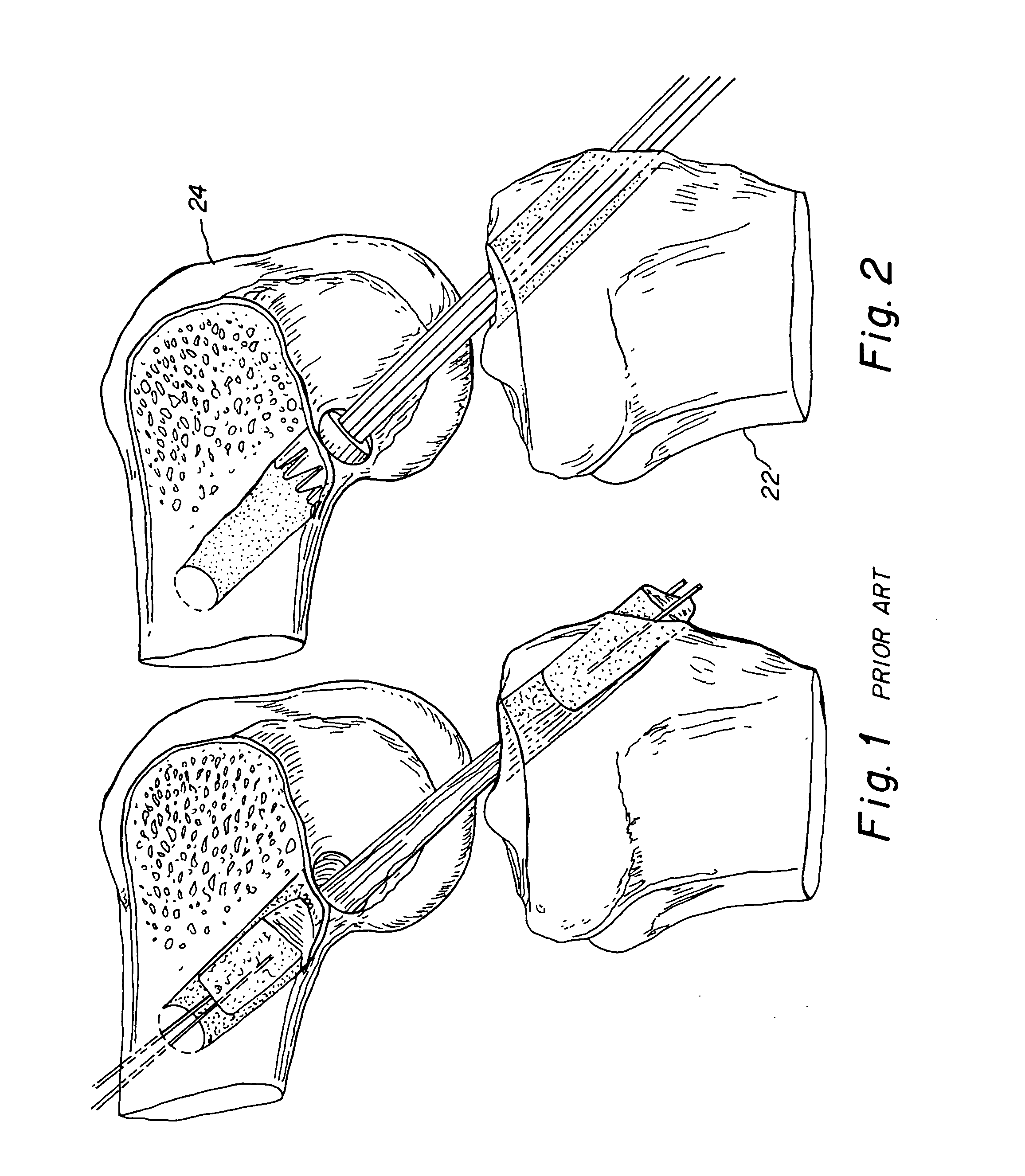 Method for inserting improved bone tendon bone assembly with allograft bone block