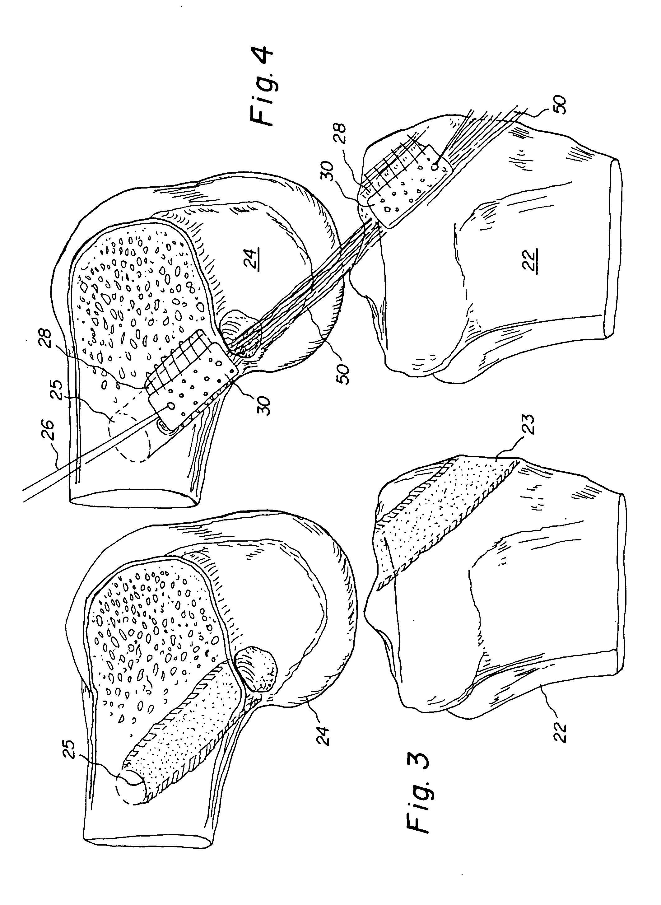 Method for inserting improved bone tendon bone assembly with allograft bone block