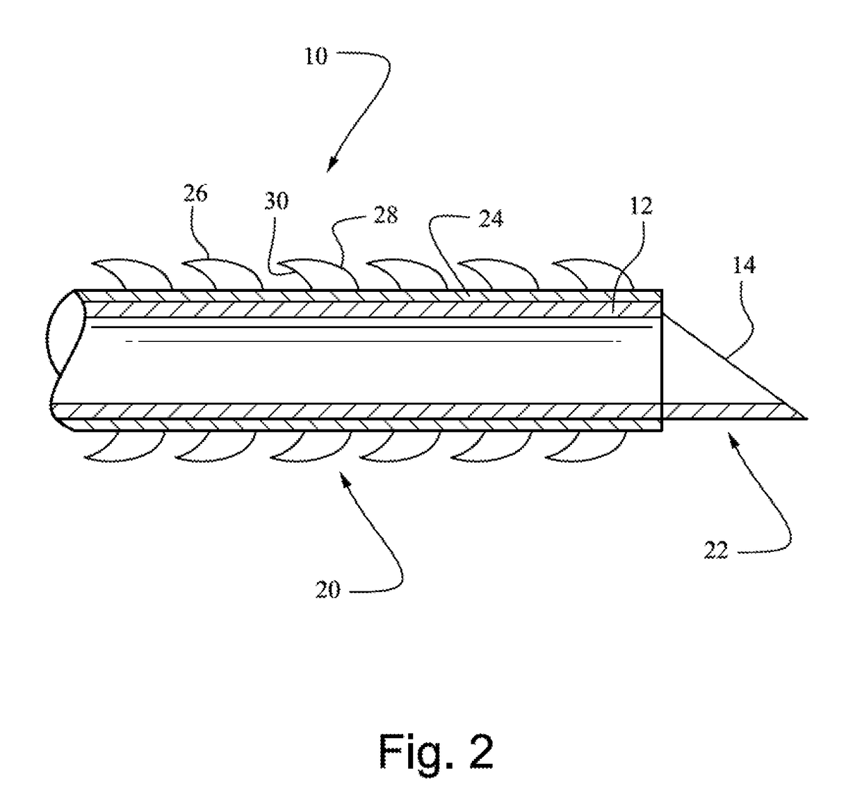 Decompression needle and method for emerency treatment of a pneumothorax