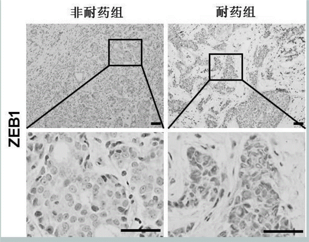 Application of transcription factor ZEB1 for preparing medicine capable of accelerating breast cancer chemosensitivity