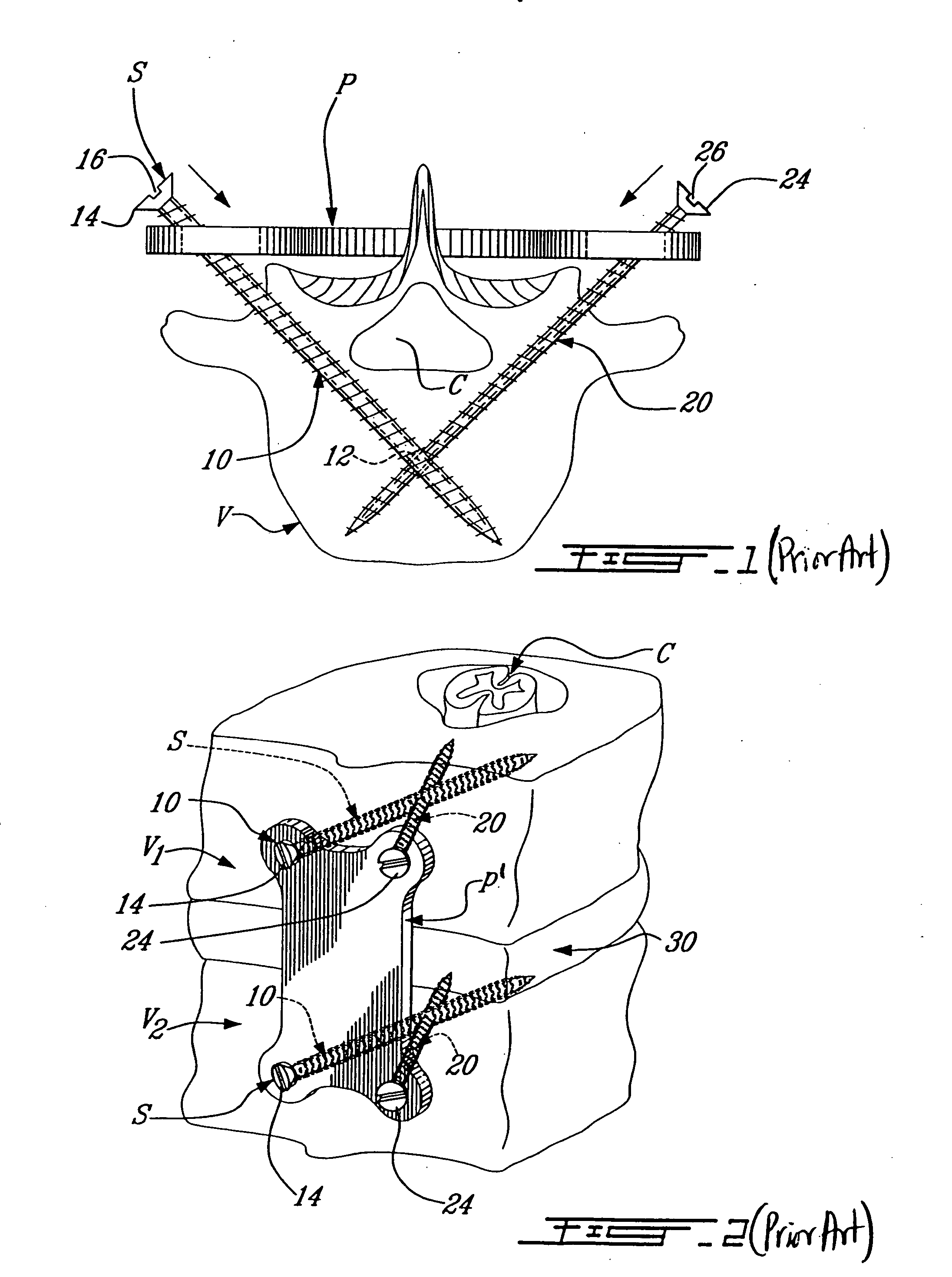 Multi coaxial screw system