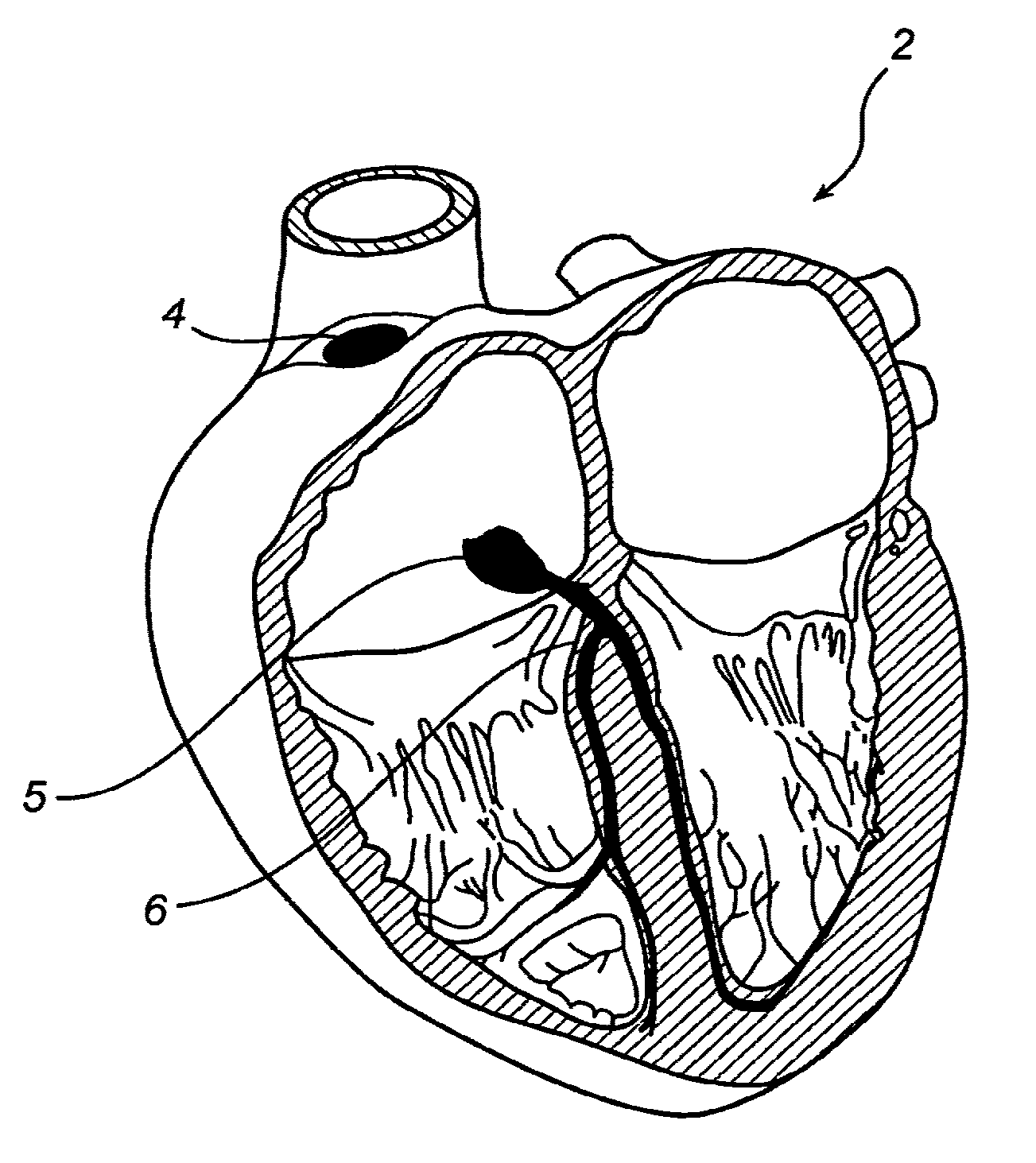 Device, A Kit And A Method For Treatment Of Disorders In The Heart Rhythm Regulation System