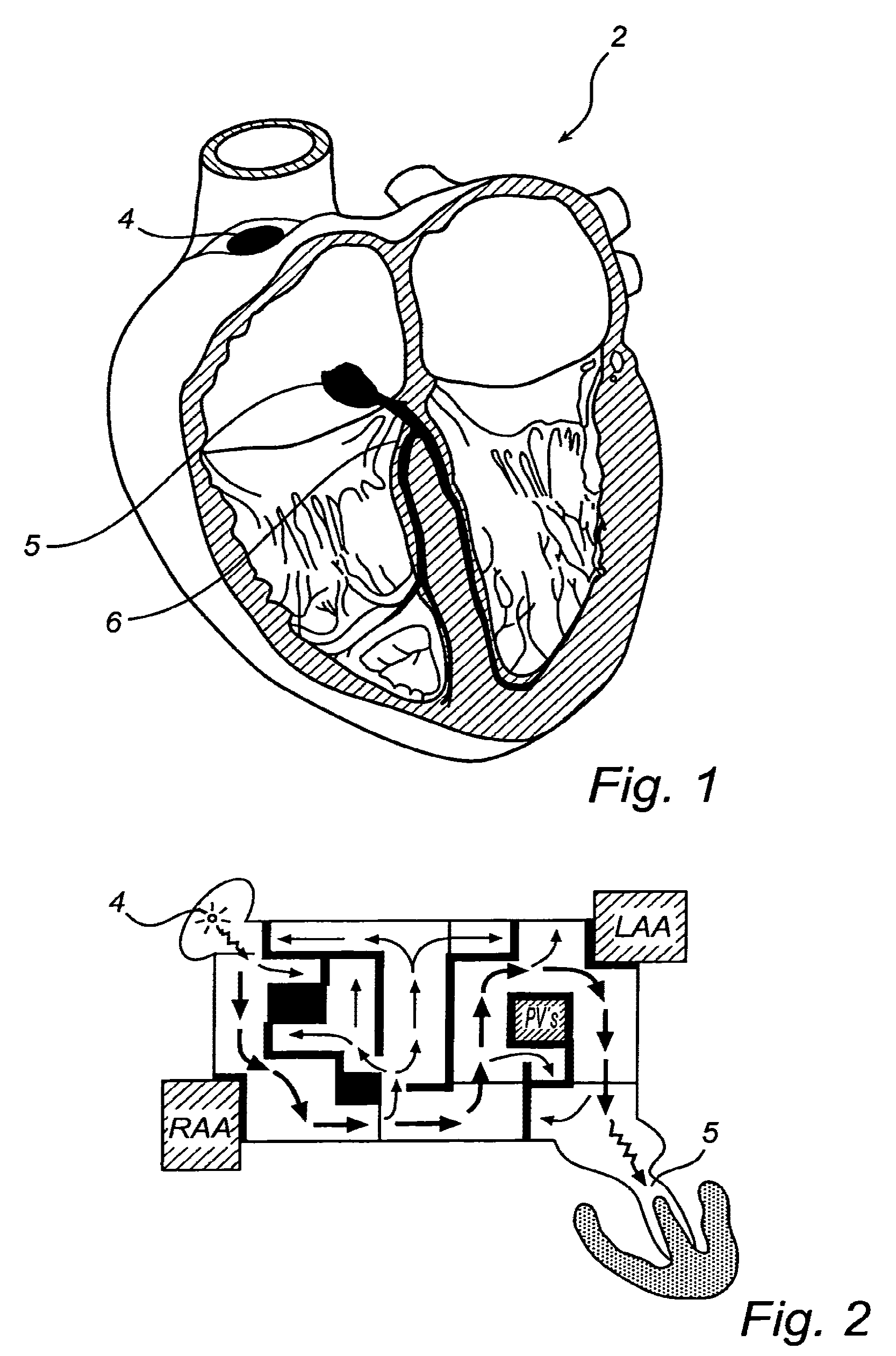 Device, A Kit And A Method For Treatment Of Disorders In The Heart Rhythm Regulation System