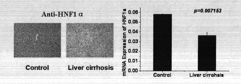 Use of hepatocyte nuclear factor-1alpha in treatment of chronic liver disease