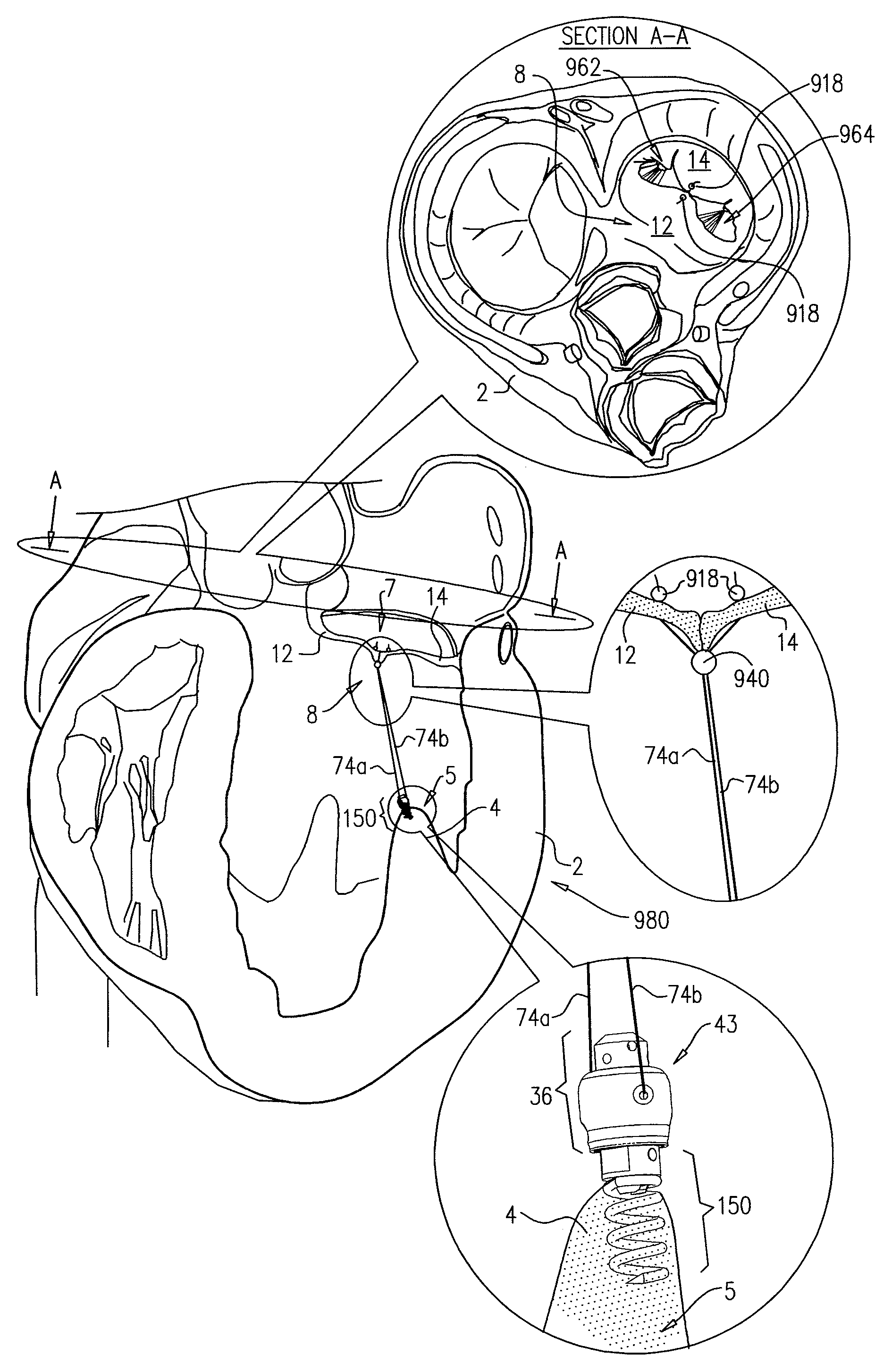 Method for guide-wire based advancement of a rotation assembly