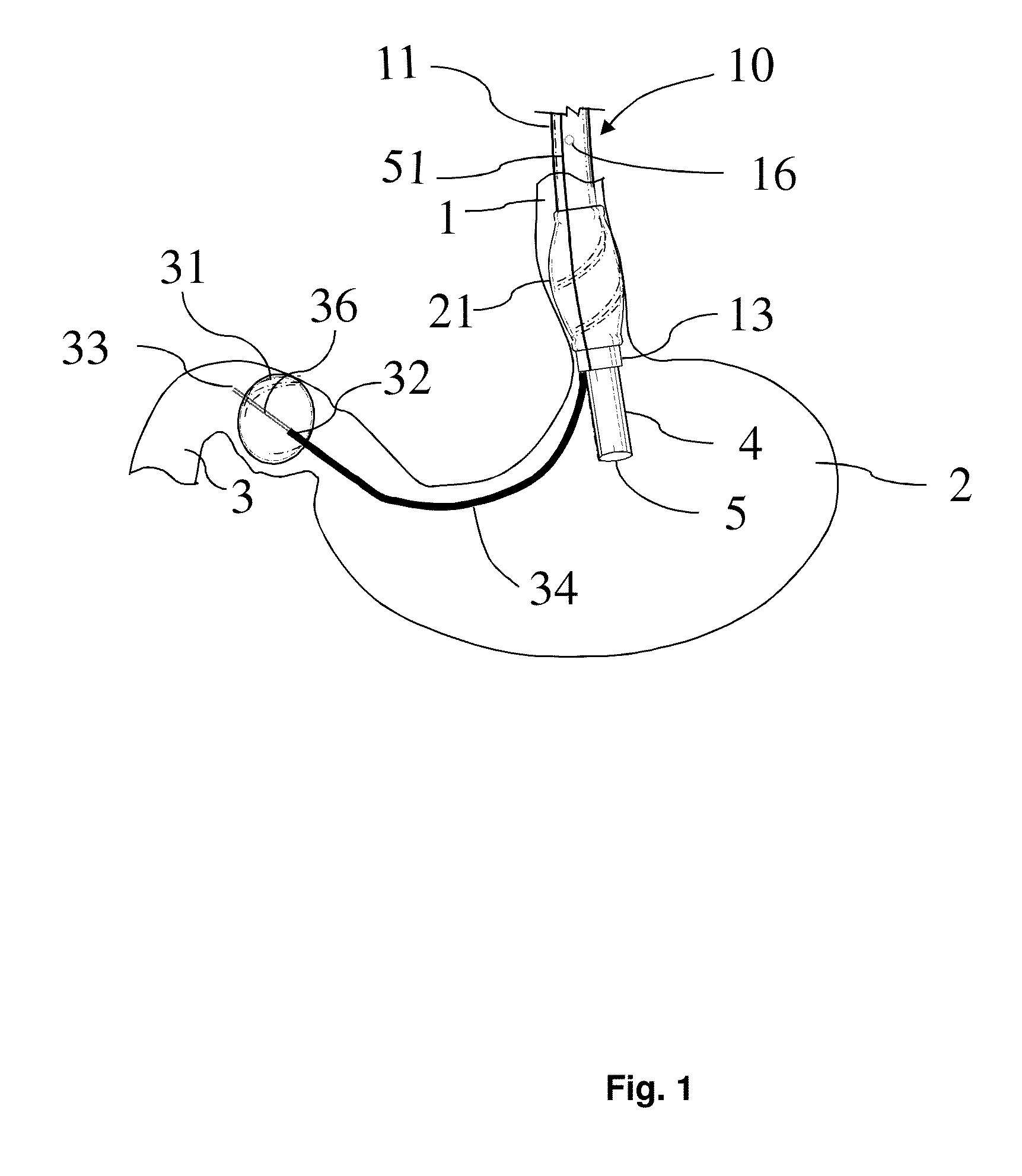 Endoscope Accessory