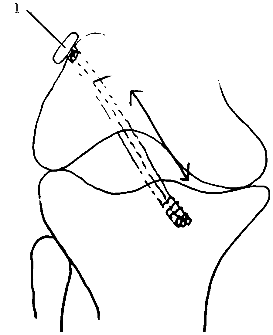 Direct suspension and fixing device for soft material tissue implant