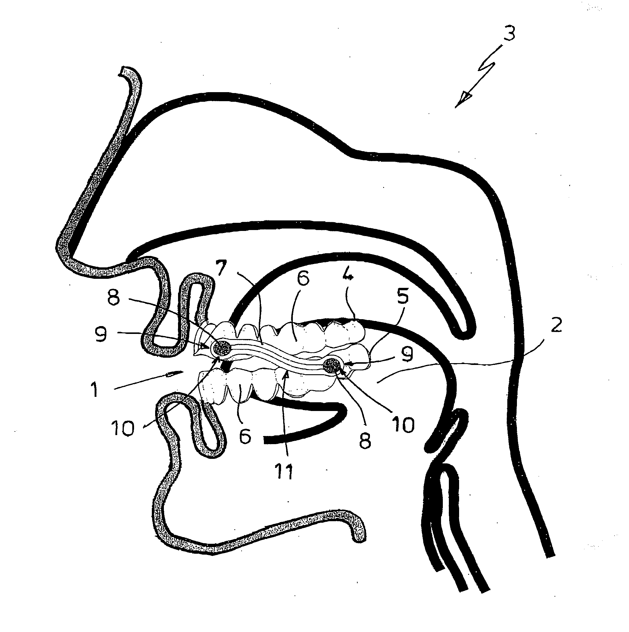 Anti-snoring device