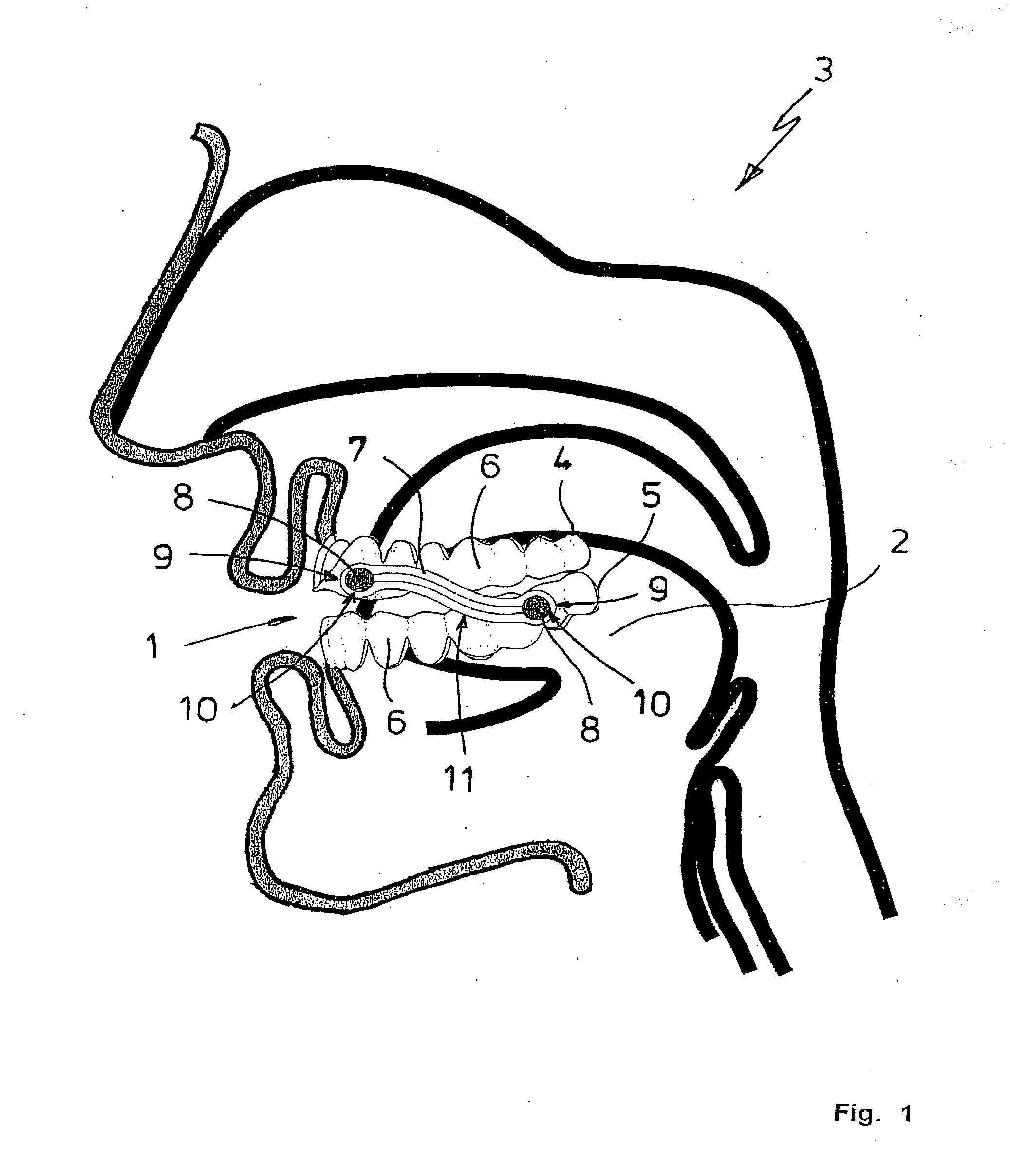 Anti-snoring device