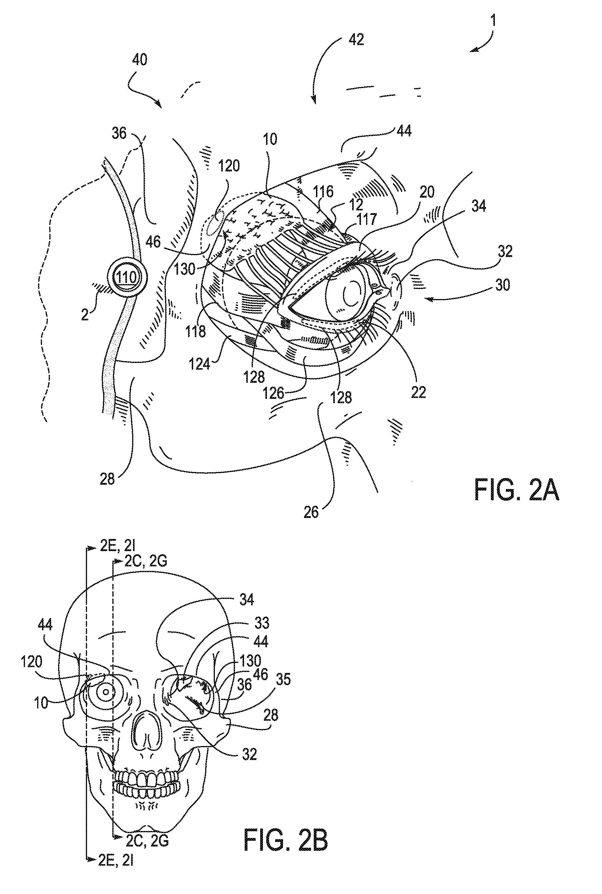 Systems and methods for treatment of dry eye